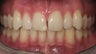 Gaps and Teeth Spacing