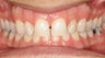 Gaps, Overbite, Invisalign