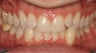 Narrow Arches, Crowding, Invisalign