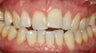 Narrow Arches, Gum Loss, Crowding