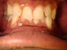 Pushing down lower teeth with Invisalign