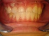 Pushing teeth over the bite and reversing a crossbite