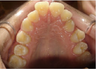 Invisalign