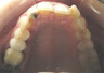Invisalign Treatment