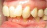Invisalign Treatment