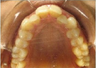 Invisalign Treatment