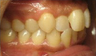 Invisalign Treatment