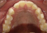 Invisalign Treatment