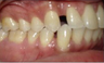 Invisalign Treatment
