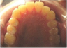 Invisalign Treatment