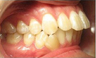 Invisalign Treatment