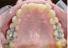Invisalign Treatment