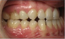 Invisalign Treatment