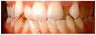 Invisalign