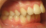 Invisalign 24 Months Severe Over Jet and Tongue Thrust