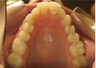 Invisalign 24 Months Severe Over Jet and Tongue Thrust