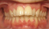 Invisalign 24 Months Severe Over Jet and Tongue Thrust