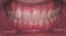 Invisalign