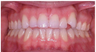 Invisalign