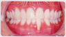 Low incisor extraction