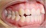 Invisalign Treatment