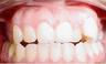 Invisalign Treatment
