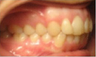 Invisalign Treatment