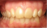 Invisalign Treatment