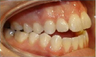Invisalign Treatment