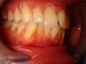 Invisalign for overlapping upper incisors
