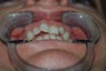Moderate anterior crowding treated with Invisalign