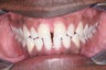 Invisalign