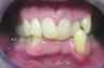 Invisalign