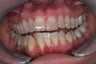 Invisalign