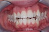 Invisalign