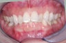 Invisalign