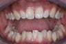 Invisalign
