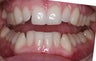 Invisalign