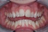 Invisalign