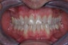 Invisalign