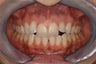 Invisalign