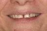 Invisalign and Cosmetic Bonding