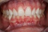 Invisalign