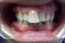 Invisalign