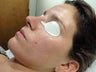 Acne Treatment via Isolaz
