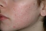 Acne and Isolaz