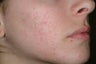 Acne and Isolaz