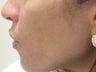 Isolaz treatment