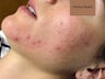 Acne Treatment via Isolaz