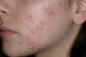 Acne and Isolaz